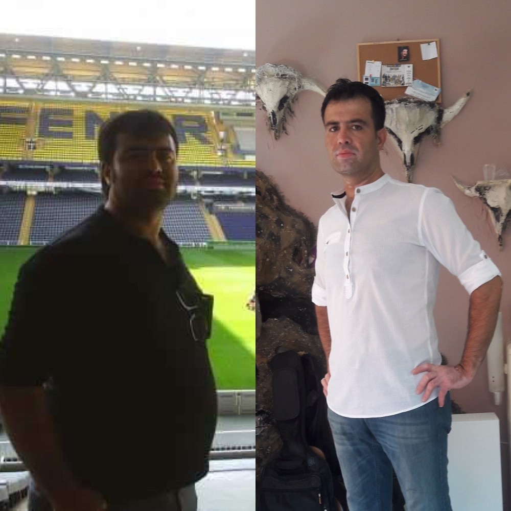 Tüp mide ameliyatıyla 42 kilo verdi