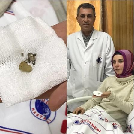Burnundaki cisimle 24 yıl yaşadı