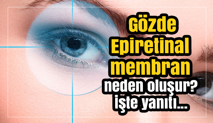 Epiretinal membran neden oluşur? İşte yanıtı...