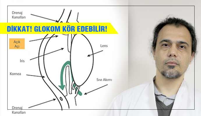 DİKKAT! GLOKOM (GÖZ TANSİYONU)KÖR EDEBİLİR