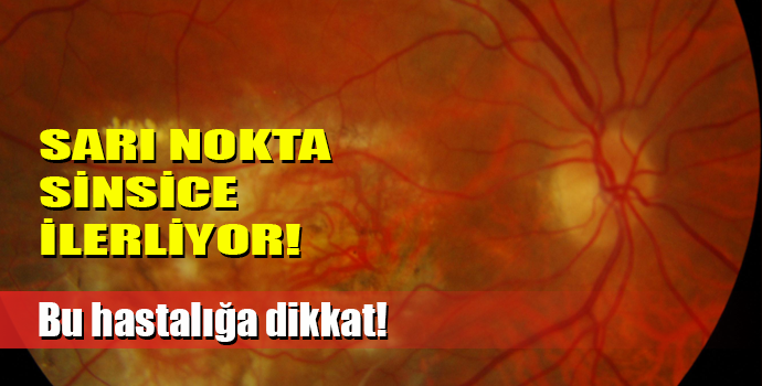 SARI NOKTA, AĞRISIZ-HABERSİZ GELİYOR!