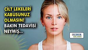Cilt lekeleri kabusunuz olmasın! Bakın tedavisi neymiş…
