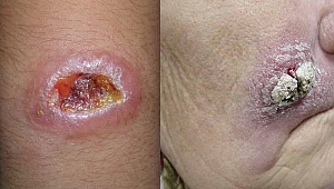 Ege'de Şark çıbanı tanısına yeni ve kombine bir yaklaşım!