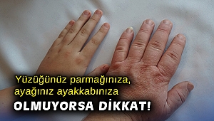 Yüzüğünüz parmağınıza, ayağınız ayakkabınıza olmuyorsa dikkat