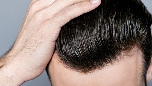 BUNLARI ÖĞRENMEDEN SAÇ EKİMİ YAPTIRMAYIN!