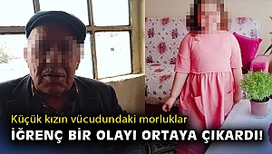 Küçük kızın vücudundaki morluklar iğrenç bir olayı ortaya çıkardı