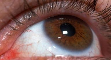 Akıllı Lens Ameliyatına Karar Verirken Uzman Hekime Danışın