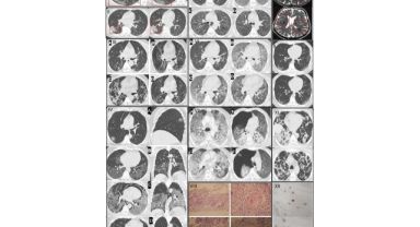 COVID salgının bıraktığı hasar, klinik araştırmalarla tespit ediliyor