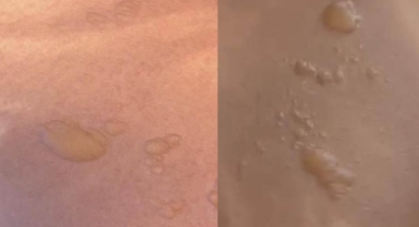 Yine sıcak su torbası yine facia: Koyduktan 3 dakika sonra patladı